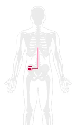 Spinal Cord Stimulator for Chronic Pain
