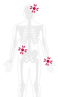 Fibromyalgia Pain Treatment