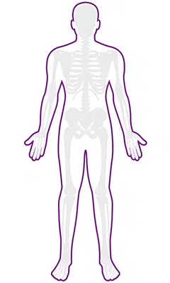 Localized Scleroderma
