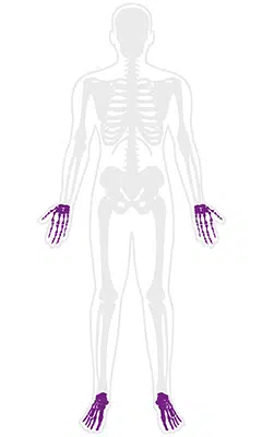 Rheumatoid Arthritis