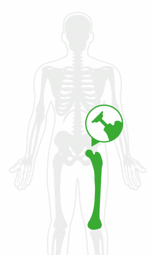 APC — Orthopedic Hip — Direct Anterior Hip Replacement