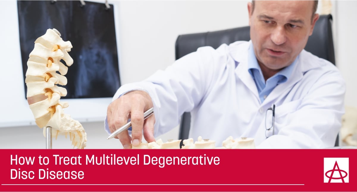 Multilevel degenerative disc disease treatment