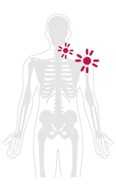 trigger point treatment​
